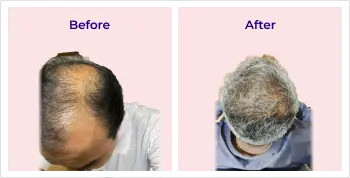 Hair transplant