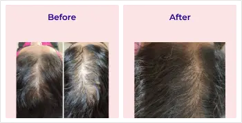 Hair transplant