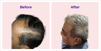 Hair transplant